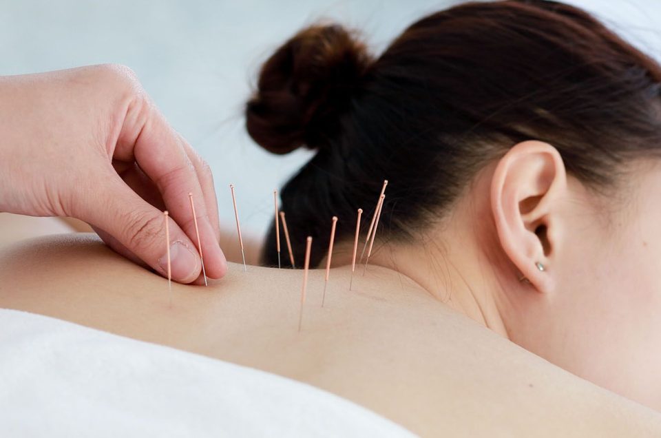 Acupuncture Cost