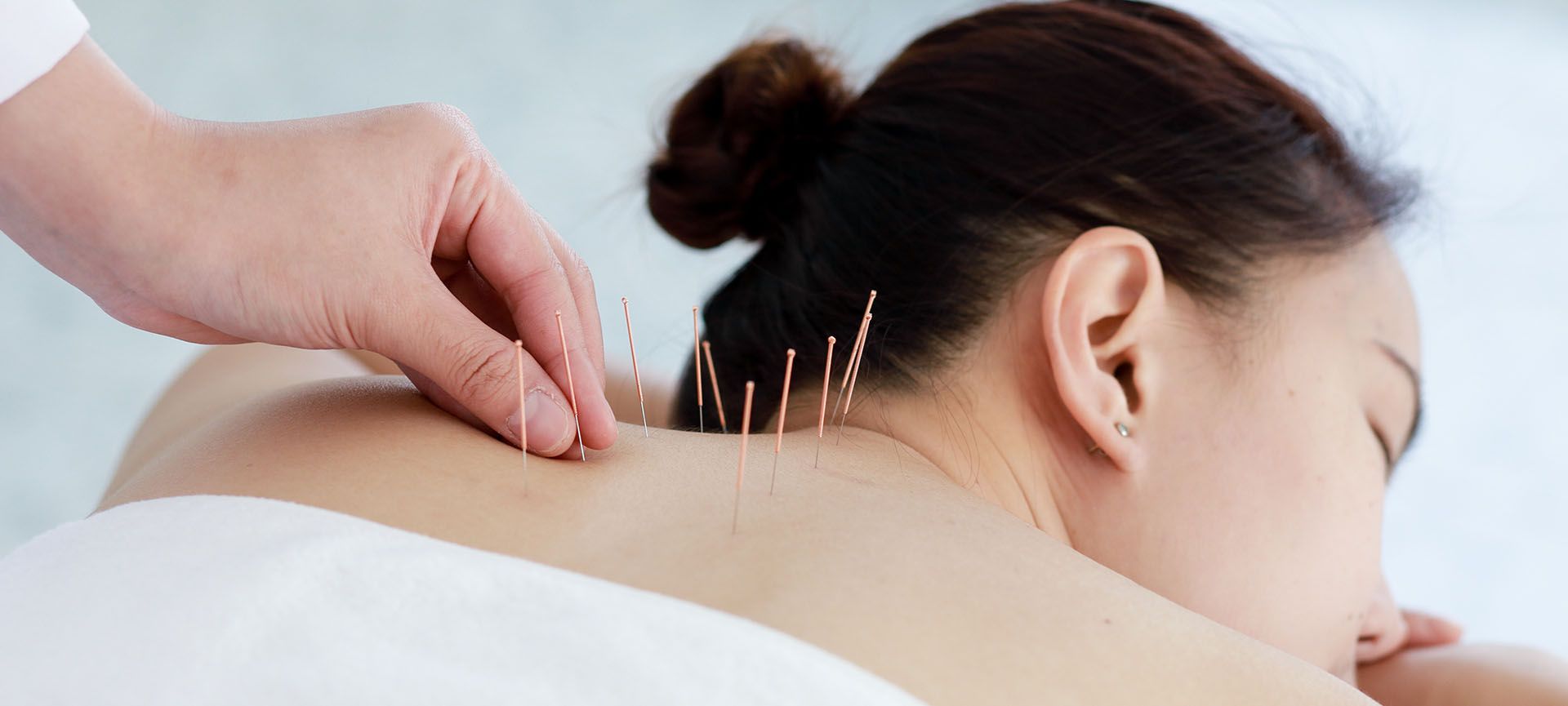 Acupuncture Cost
