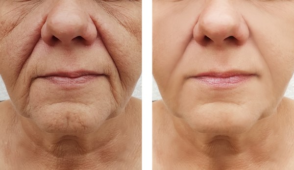 Morpheus8 treatments sunny isles fl
