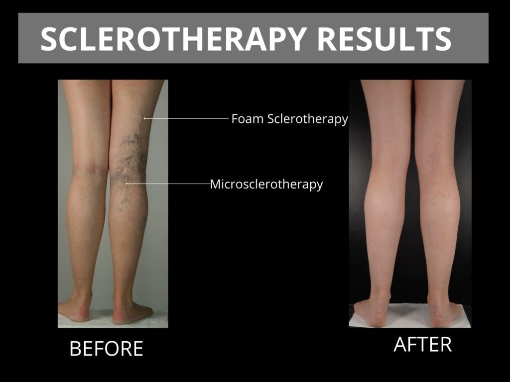 Sclerotherapy therapy sunny isles fl
