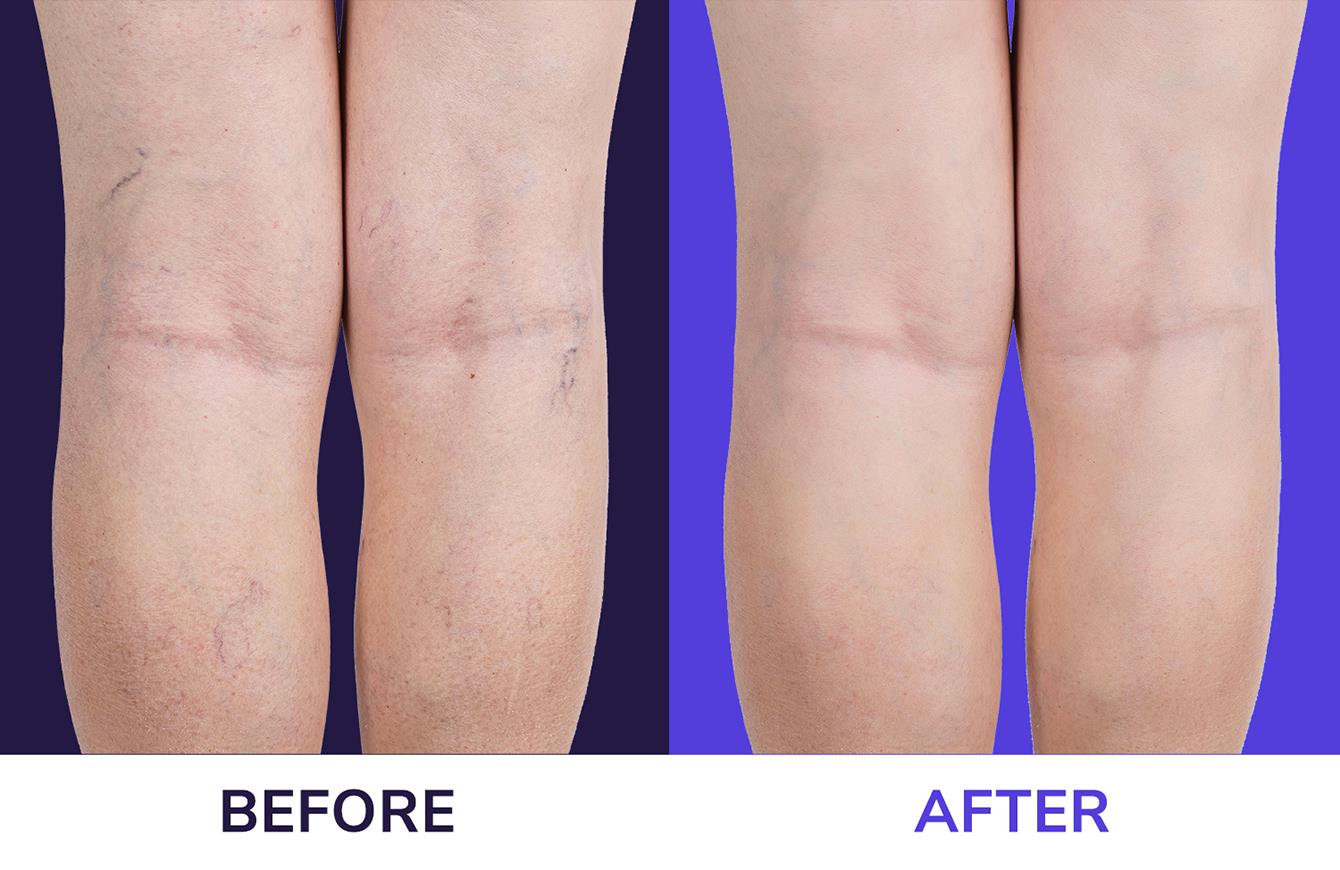 Varicose & Spider Vein Injections treatment sunny isles fl