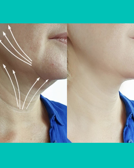 Double Chin & Jawline Sculpting Treatment