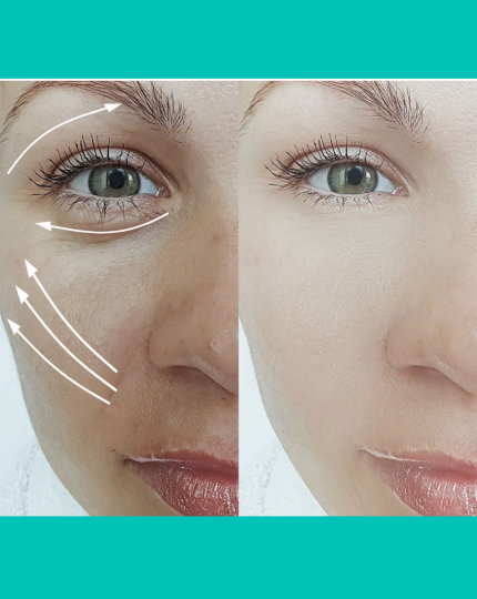 Eye Bags & Under-Eye Puffiness Treatment