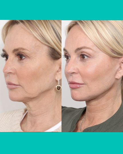 Non-Surgical Facelift